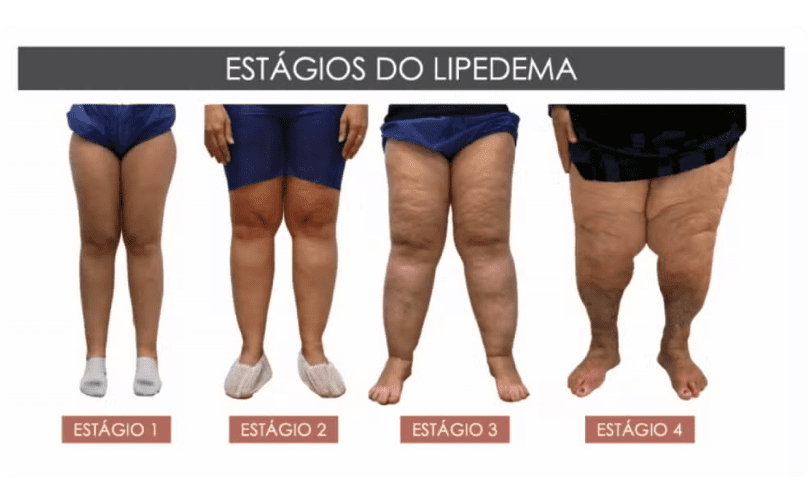 Estágios diferentes de lipedema — Foto: Reprodução EPTV