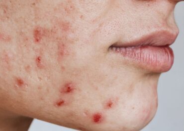 Imagem: Mulher com acne no rosto.